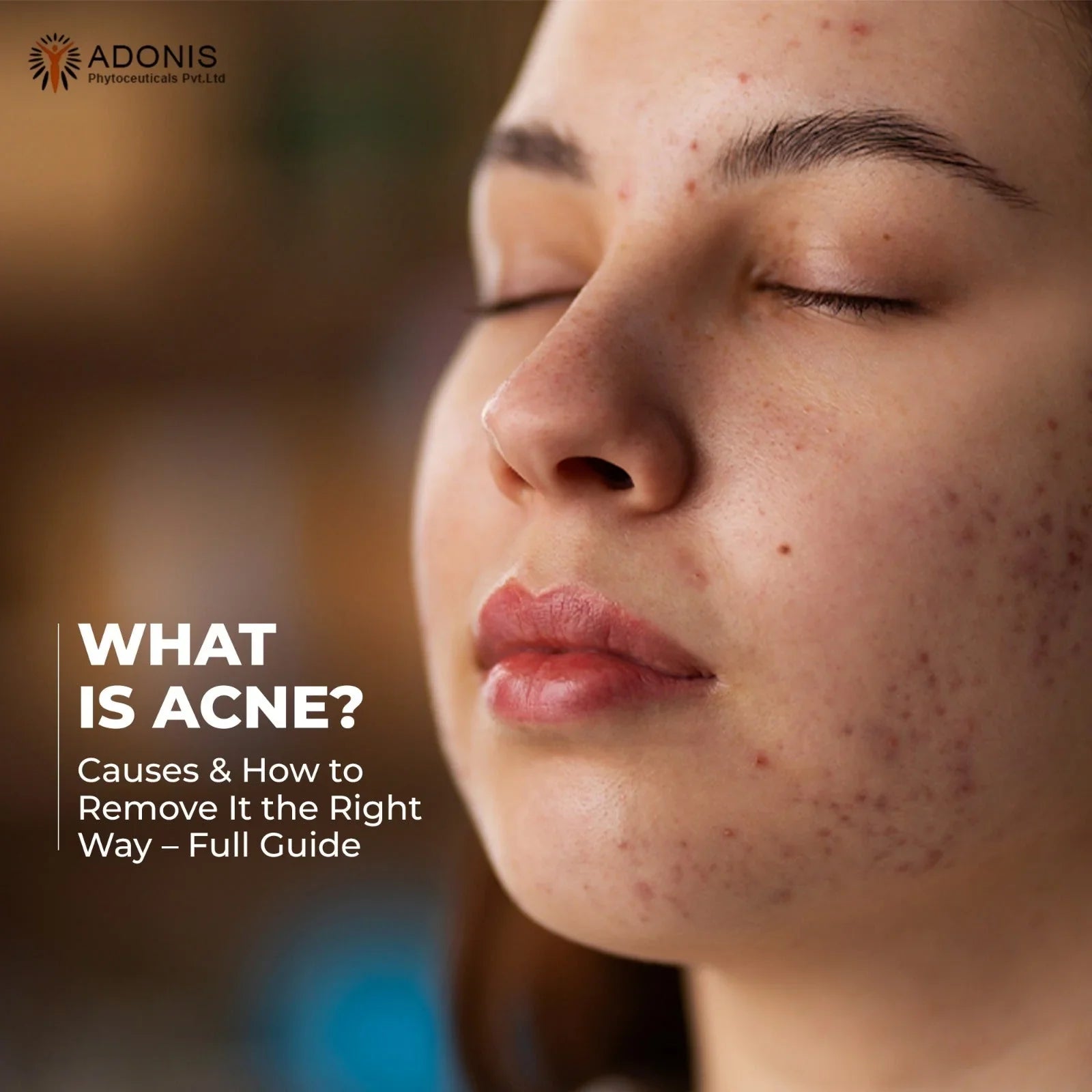What Is Acne? Causes & How to Remove It the Right Way – Full Guide