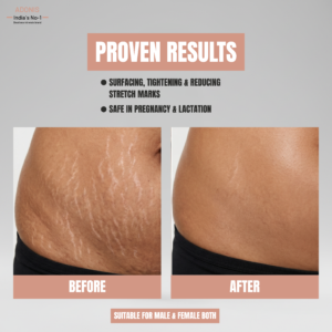 STRIE Stretch Marks Removal Cream