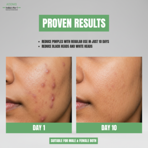 DS ANTI-ACNE FACEWASH | Acne Control Face Wash | Reduces Pimples, Blackheads & Excess Oil | For all skin types | Suitable for both men and women | 100ml