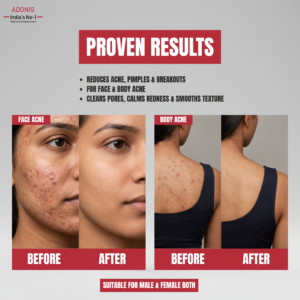 KITAVA GEL – Anti Acne Gel | Adonis img_ 6