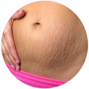 STRETCH MARKS