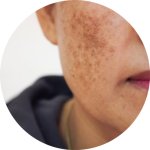 PIGMENTATION